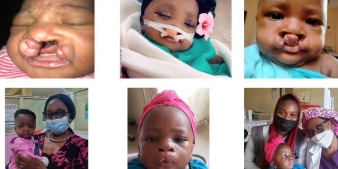 Orthodontics: Missing Link in Comprehensive Cleft Care for Nigeria and Africa